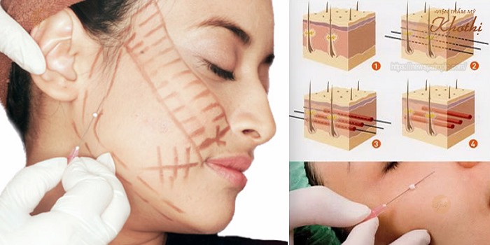 Căng da mặt bằng chỉ collagen là gì?