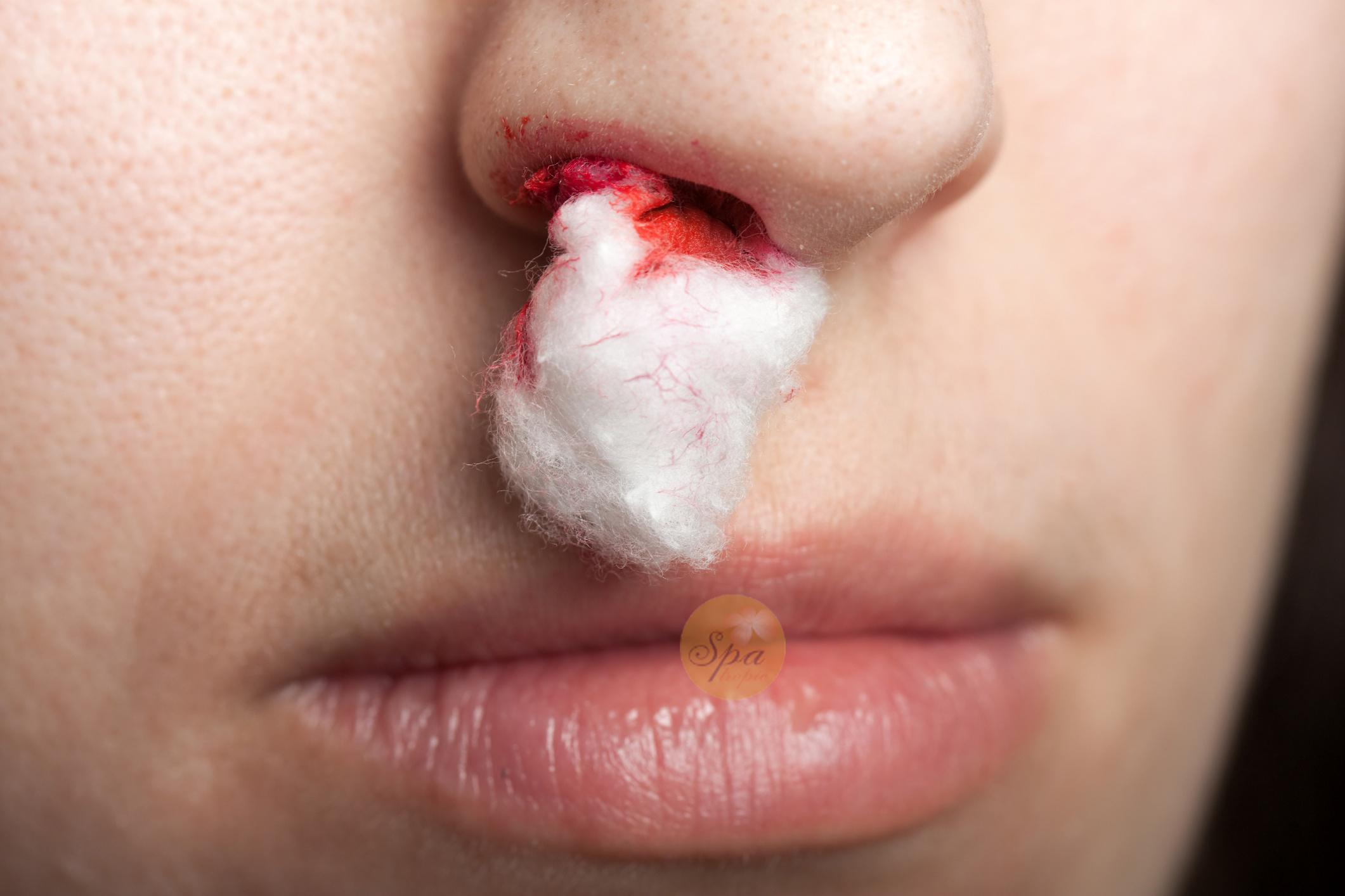 Mũi chảy máu là dấu hiệu có thể xảy ra sau nâng mũi, bạn cần đến bác sĩ càng sớm càng tốt nếu gặp phải